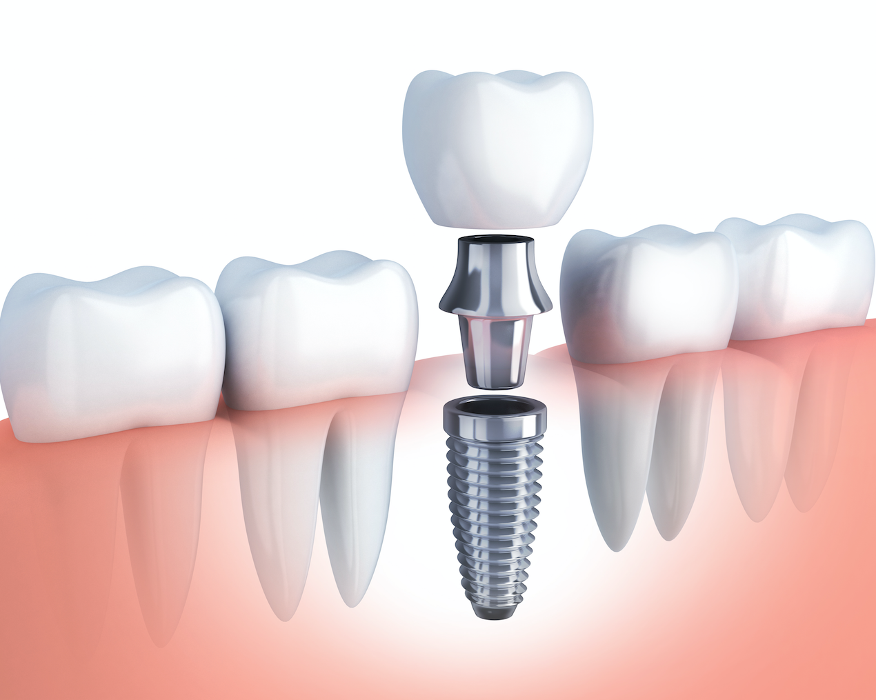 Renommierte Implantatsysteme für perfekten Zahnersatz