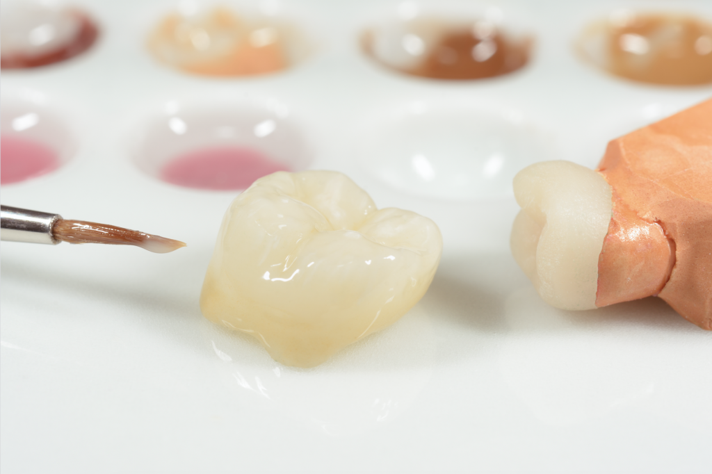 Zahnfarbenbestimmung -feinste Farbnuancen für einen neuen Zahn