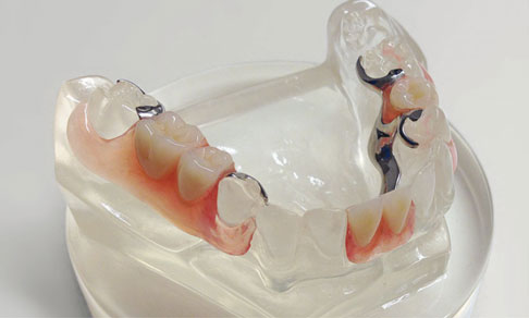 Valplast - innovativer Zahnersatz