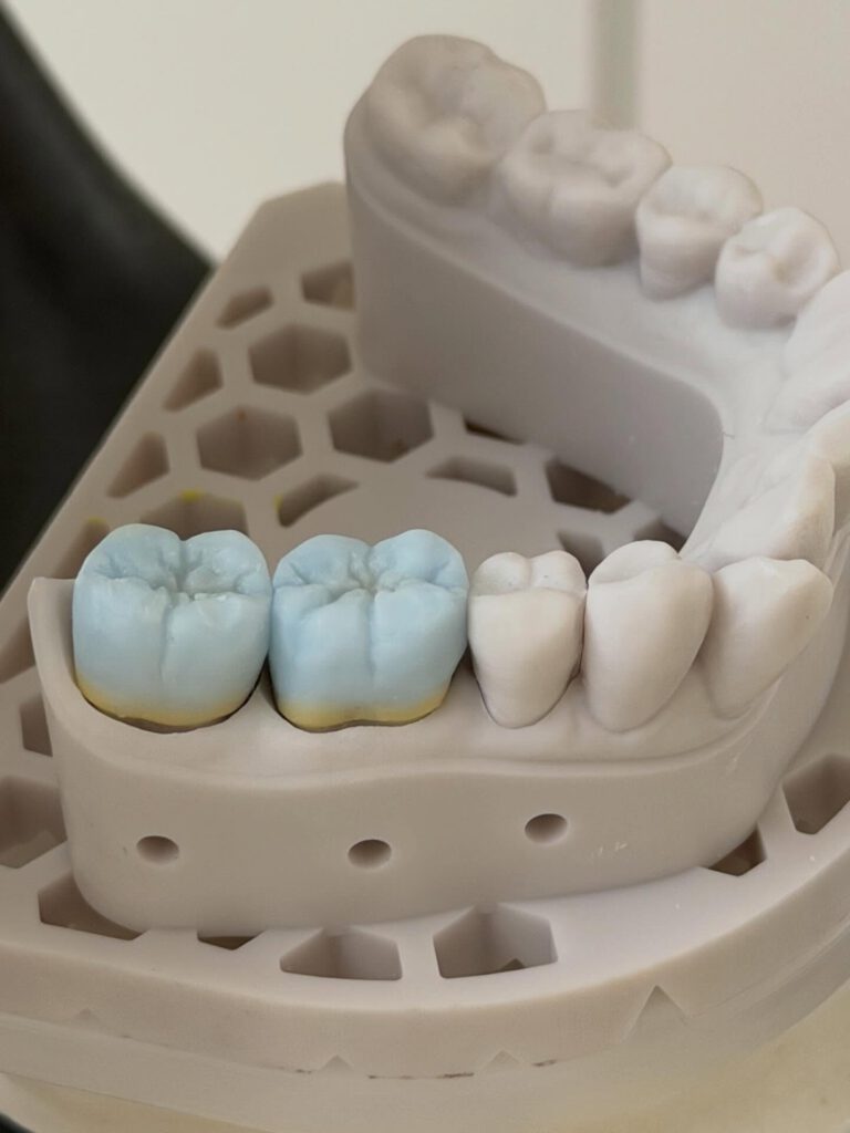 Die Herstellung von E-Max-Kronen auf 3D-gedruckten Modellen steht exemplarisch für den Fortschritt in der Zahntechnik. Digitale Technologien ermöglichen nicht nur effizientere Abläufe, sondern auch eine deutlich höhere Qualität in der Patientenversorgung. Zahnarztpraxen und Dentallabore, die auf diese moderne Kombination setzen, profitieren von Präzision, Schnelligkeit und überzeugenden Ergebnissen.